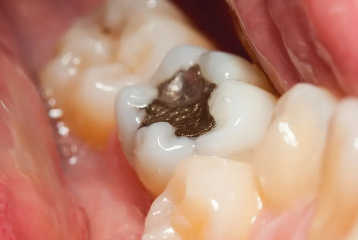 Dpi Amalgam Capsules