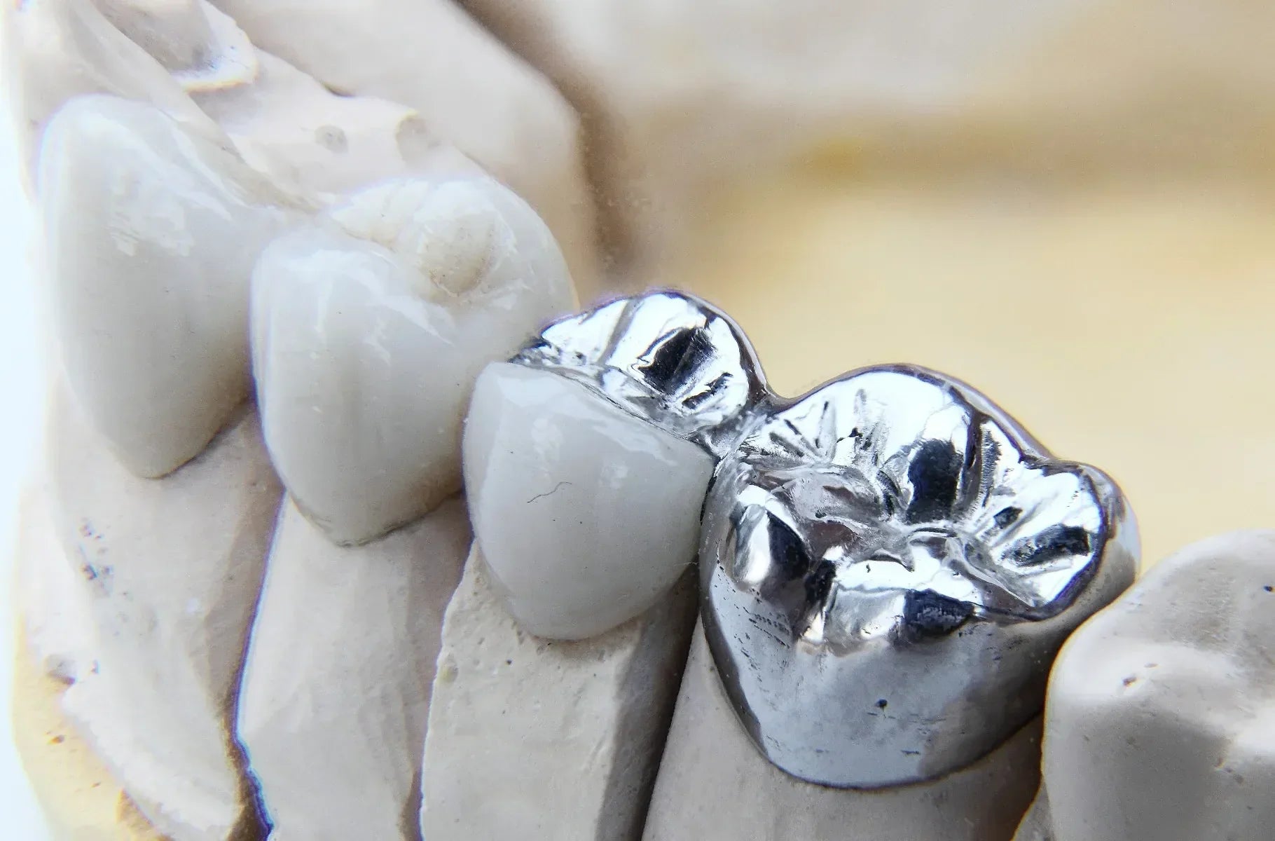 Dentsply StarLoy N Dental Alloy Metal