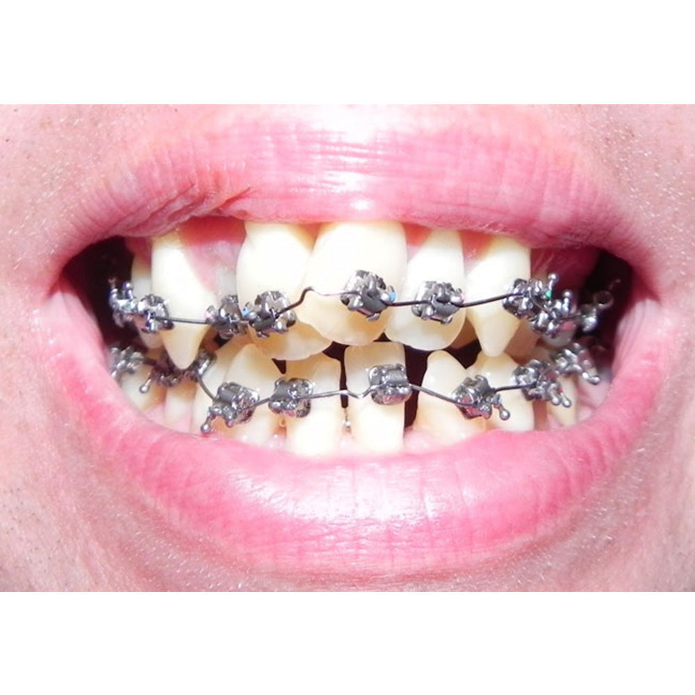 D-Tech Precimax (MIM MBT Prescription Brackets)