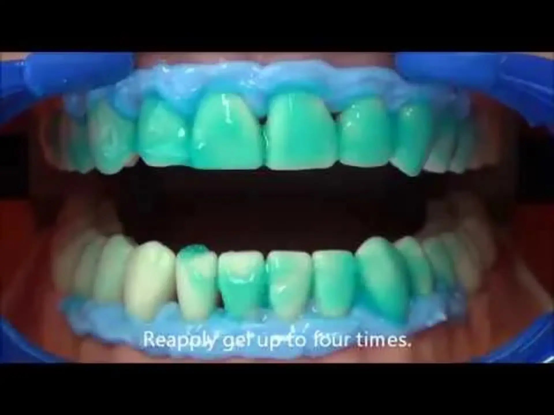 SDI Pola Office 3-Patient Teeth Polishing & Whitening Dental Kit
